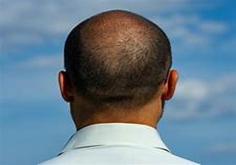 Ideal time for a hair transplant for balding men