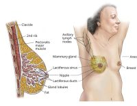 Breast tumor
