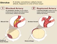 World Stroke Day