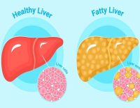 Fatty Liver