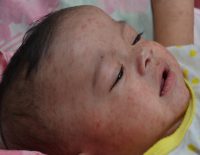 World Down Syndrome Day