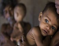 malnutrition among children