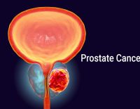 Prostate Cancer