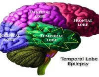 AIIMS Study on Epilepsy