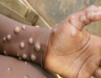 health illiteracy in India