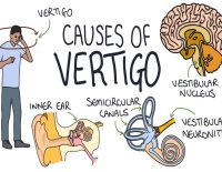 Vertigo